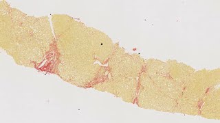 HISTALIM Chronic diseases  Hepatic fibrosis collagen quantification on human liver [upl. by Kelvin758]