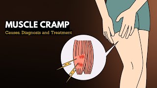 Muscle cramp Causes Signs and Symptoms Diagnosis and Treatment [upl. by Terb]