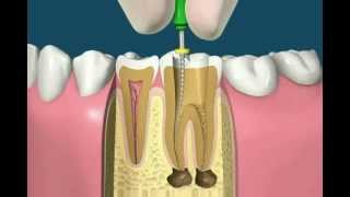 Root Canal Procedure [upl. by Cardinal889]