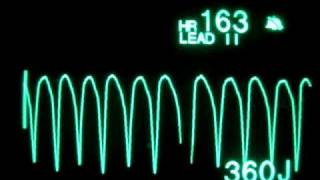 Pulseless Ventricular Tachycardia pVT  Monophasic Defibrillation at 360 Joules [upl. by Gilboa106]