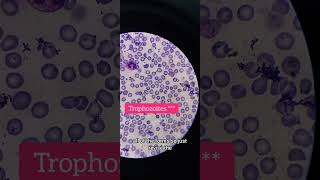 MP slide Plasmodium vivax on oil immersion 100× laboratory hematology [upl. by Aineles]