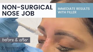 NonSurgical Nose Job Live Nose Filler Procedure [upl. by Backer]