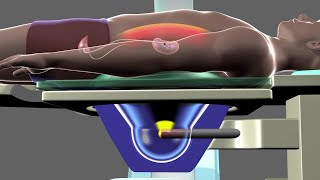 Shockwave Lithotripsy [upl. by De]