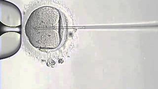 Intracytoplasmic Sperm Injection Procedure ICSI [upl. by Northrup]