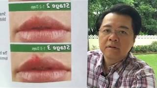 Sakit sa Balat Butlig Cold Sore Pigsa Maitim na Balat  Payo ni Doc Willie Ong 569 [upl. by Chanda]