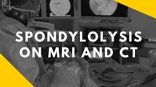 spondylolysis on CT and MRI [upl. by Mac]