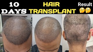 My 10 days hair transplant result Donor area condition swelling [upl. by Innos228]