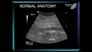 Abdominal aortic aneurysm ultrasound [upl. by Adas]