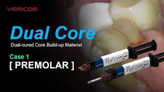 Dual Cured Core Build up Material Prmolar 1 [upl. by Quick]