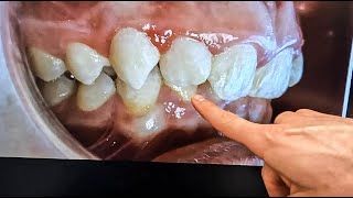 How to FIX your Overbite…complete walkthrough  Orthodontist explains [upl. by Ancier]