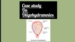 Case study On Oligohydramnios ll GNM ll BSC [upl. by Engapmahc]