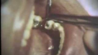 Bone Graft Into an Intrabony Pocket [upl. by Adekam]