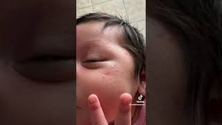 Como quitar los granitos en la cara de los bebes piel atopica o dermatitis en bebes recien nacidos [upl. by Jun451]