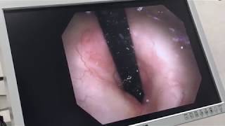 Bladder Cystoscopy Clean of tumors again Feb 2019 [upl. by Ccasi]