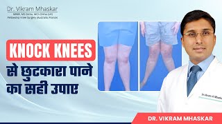 Knock Knees से छुटकारा पाने का सही उपाए  Knock Knee Problem Solution  Dr Vikram Mhaskar [upl. by Phoebe]