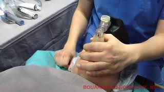 Airway Management with Airtraq in difficult airway situation [upl. by Cromwell172]