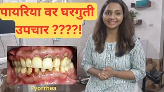 पायोरिया चे कारणे लक्षणे आणि उपचार  Pyorrhea  Causes Symptoms and Treatment [upl. by Puduns17]