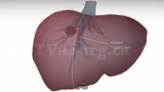 Standard right hepatectomy [upl. by Varin]