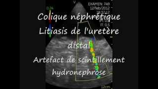 Vscan Calculs uretère distal Artefact scintillement Hydronephrose [upl. by Clapper]