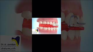 Devices to Correct an Underdeveloped Lower Jaw dentist functional orthodontist Smalllowerjaw [upl. by Indira]