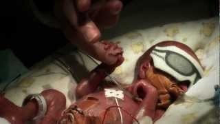 24 week premature baby  Tobys journey [upl. by Stilwell791]