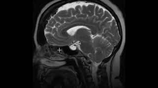 Pseudotumor cerebri and hyperostosis frontalis interna [upl. by Layton23]