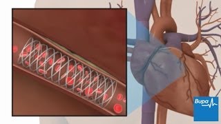 How coronary angioplasty is carried out  Bupa Health [upl. by Brenza]