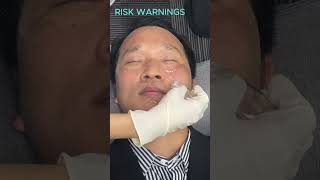 Microneedling Before And After  DIY Microneedling at Home microneedling mesotherapy aesthetic [upl. by Icyak]