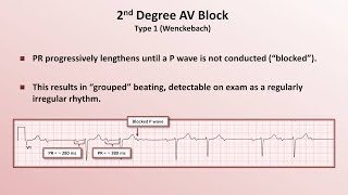 Intro to EKG Interpretation  AV Block [upl. by Jeraldine]