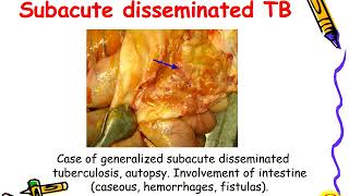 Disseminated tuberculosis [upl. by Eelyma592]