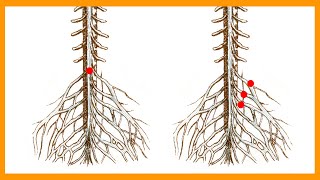 Cauda Equina vs Conus Medullaris Syndrome [upl. by Neeneg]