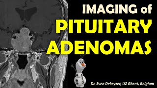 Imaging of Pituitary Adenomas [upl. by Tennes]