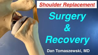 Shoulder Replacement surgery and recovery [upl. by Medina336]