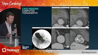 Low Risk Severe Aortic Stenosis A Case Presentation [upl. by Ecyak580]