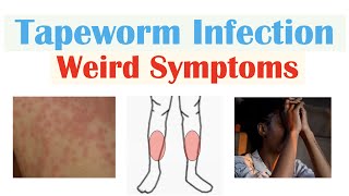 Weird Symptoms of Tapeworm Infection Skin Psychological Neurological [upl. by Pega]