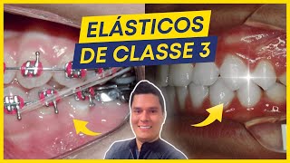 7 CUIDADOS AO USAR OS ELÁSTICOS DE CLASSE 3 [upl. by Thibaut924]