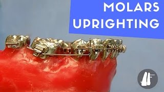 UPRIGHTING MOLARS [upl. by Liryc]