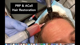 PRP amp ACell Hair Restoration  Dr Weiner Narrates His Own Treatment [upl. by Nnahgaem]