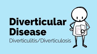 Diverticular Disease  Diverticulitis  Gastrointestinal Society [upl. by Jania]