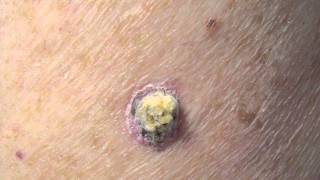 How Dangerous is Squamous Cell Carcinoma [upl. by Nnaj]