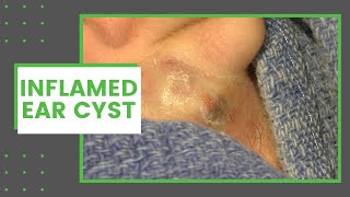 Cyst Excision  Surgical excision of a cyst on the earlobe [upl. by Ynnavoj906]