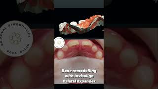 Invisalign Palatal Expander Skeletal expansion for growing patients [upl. by Marven962]