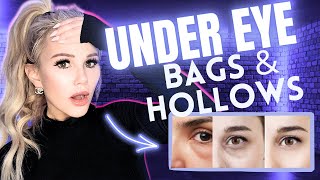 How to REMOVE UnderEye Bags amp Hollows best treatments [upl. by Anailli794]