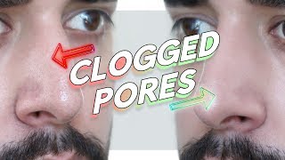 Clogged  Enlarged  Congested Pores  How To Prevent Forever ✖ James Welsh [upl. by Mattox]