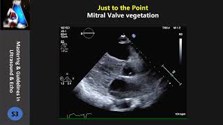 Mitral Valve vegetation [upl. by Ibbie]