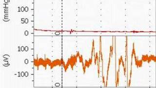 Bupivacaine Cardiotoxicity in an Anesthetized Rat [upl. by Jordanna]