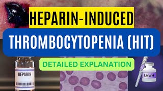 HeparinInduced Thrombocytopenia HIT Types Pathogenesis Diagnosis and Treatment [upl. by Nnyltak]