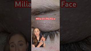 Get Rid Of Your Milia For Good dermatologist [upl. by Hilbert]