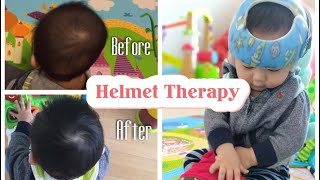 12 Weeks Progress Helmet Therapy For Flat Head SyndromePlagiocephaly [upl. by Alanna]