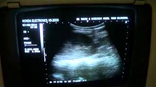 PYELONEPHRITIS vs INTERSTITIAL NEPHRITIS vs NEPHROTIC SYNDROME [upl. by Ocirne]